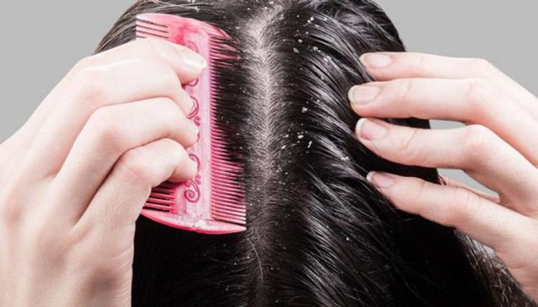 طريقة إزالة القشرة من الشعر نهائيًا..لن تصدقي النتيجة