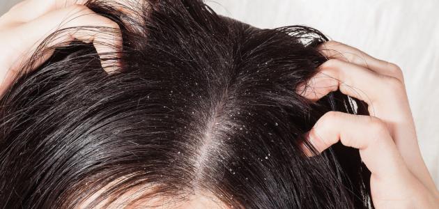 طريقة إزالة القشرة من الشعر نهائياً
